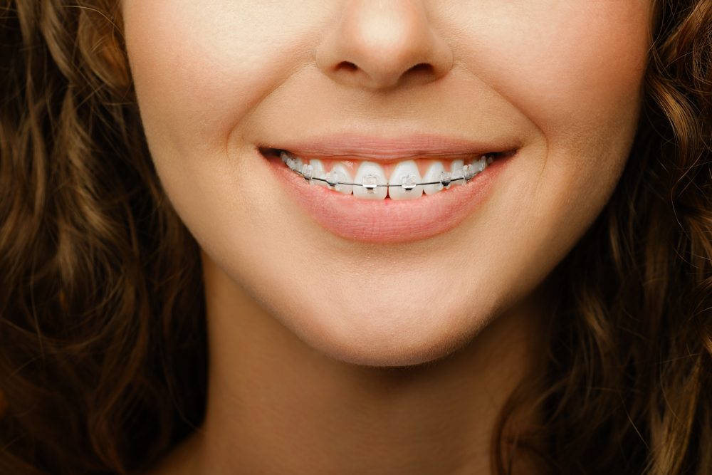 Picture of a girl smiling with braces on her teeth.